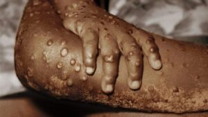 Monkeypox Virus: WHO की चिंता बढ़ी, आपातकालीन बैठक की बुलाई; वैश्विक रोग हो सकता है घोषित