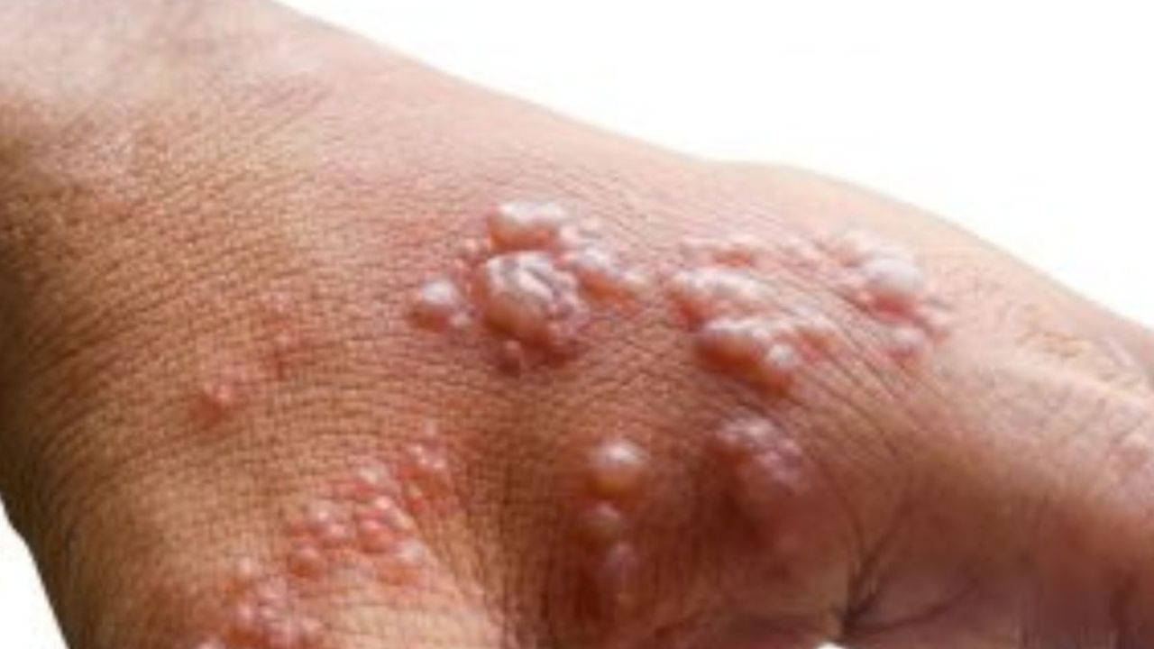 Monkeypox Virus: WHO की चिंता बढ़ी, आपातकालीन बैठक की बुलाई; वैश्विक रोग हो सकता है घोषित